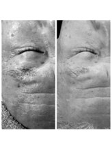 ディープブルー(Deep Blue)/プラペンデュアル施術