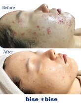 ビズビズ(bisebise)/