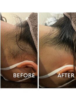 グリン(grin)/ワックス脱毛(１）