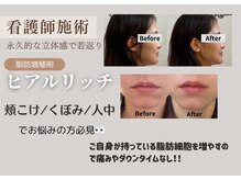 スリーメイ(3mey)の雰囲気（ヒアルリッチ（脂肪増殖剤使用）脂肪ヒアルでコケ改善）