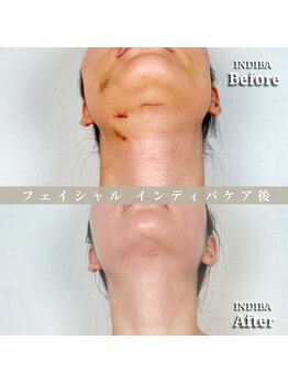 術後の女神 大阪心斎橋店/術後ケアインディバ・インディバ