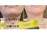 韓国発!脂肪分解フェイスライン★LEMON BTTLE 2cc+本格顔コルギ10分