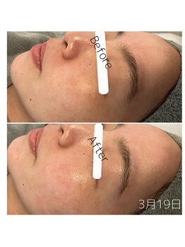 エヌプラス(N+)/30代女性＊ピーリング直後