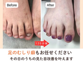 ネイルサロン プロムナード(nailsalon promnade)/フット深爪矯正☆即日見た目改善
