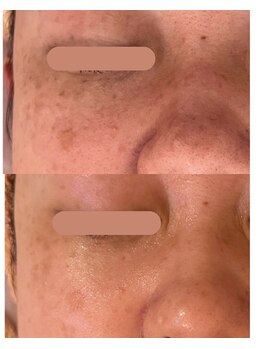 ジャスミン(Jasmin)/プラペン×幹細胞