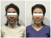 シンメトリー 麻布十番/Before/After
