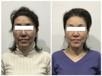 シンメトリー 麻布十番/Before/After