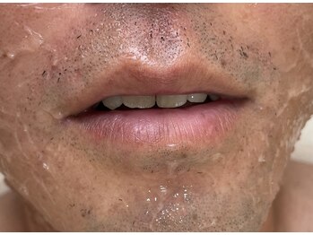 エナッシュビューティサロン(ENASH)/メンズヒゲ脱毛