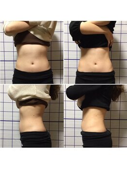 アリス フィットネスサロン/*ウエスト施術効果*