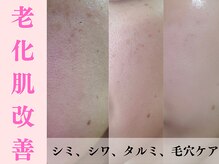 ラクワン(R coin)の雰囲気（シワ・たるみ改善老化肌へ高濃度ヒト幹細胞水光導入¥13,200）