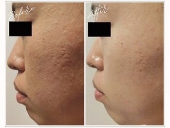 ミューベル(MYubelle)/毛穴ケア 水光ピーリング