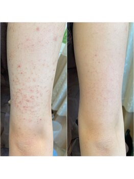 リベル 名古屋(Lebelle:)/ハーブピーリング専門名古屋