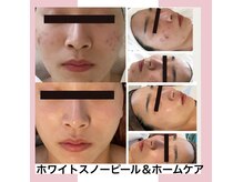 カナウ produced by きょうわ整体院(Kanau.)の雰囲気（乳酸ピーリング＆ホームケア☆黒ずみ改善、リフトＵＰ効果大！）