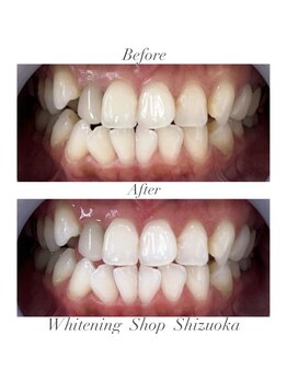 ホワイトニングショップ 静岡店/ホワイトニングBefore→After