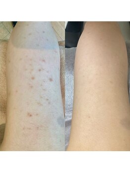 リベル 名古屋(Lebelle:)/ハーブピーリング専門名古屋