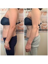 ネイルアンドリラクゼーション アン(nail&relaxation An)/脂肪冷却4カップ