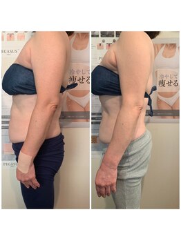 ネイルアンドリラクゼーション アン(nail&relaxation An)/脂肪冷却4カップ