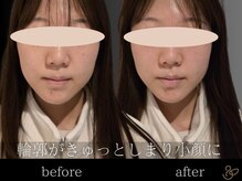 チョコバリ 郡山店(chocobari)/小顔×リフトアップ(美容鍼)20代