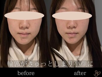 チョコバリ 郡山店(chocobari)/小顔×リフトアップ(美容鍼)20代