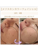 マールム(MALUM)/20代のノーファンデ肌　