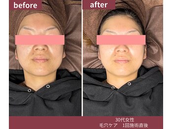 ウェルネス ステーション リンク(Wellness Station Link)/毛穴ケア ビフォーアフター