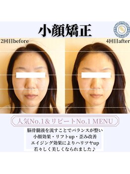 RKY/小顔矯正&頭蓋骨矯正4回(30代)