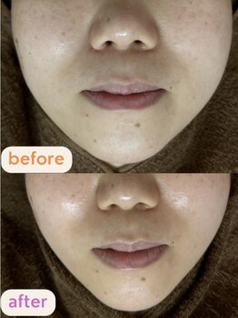 サクラ(SAKURA)/小顔矯正♪