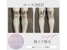 ゼロ 松阪店(ZERO)/膝上下脱毛