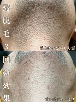 サロン ド マキ(Salon de Maki)/少ない回数で最大限の効果を!