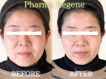 レイネ(REINE)/ファーマリジェネ/フェイシャル