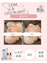 肌イズム 守谷店(肌ism)/【before&after】ララピール+LDM