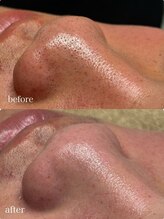 ハク 銀座(HAK.)/毛穴洗浄(小鼻ケア)Before/After