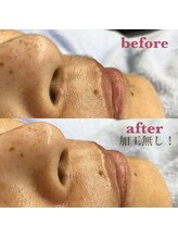 イサミ(ISAMI)/口周りうぶ毛ケア