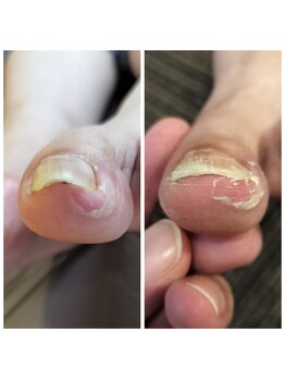 巻き爪 初回の術前・術後