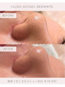 ファシネアオヤマ(FACINE AOYAMA)/毛穴洗浄1回での効果♪