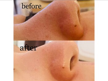 スターリィ スカイ(Starry☆Sky)/《ハイドロ毛穴洗浄》1回施術