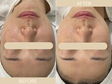 エクラ(eclat)/施術回数：1回