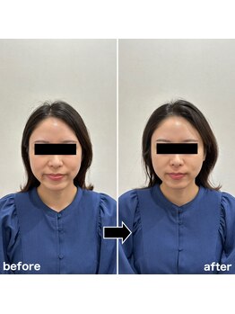 フロー鍼灸整体院(FLOW鍼灸整体院)/美容鍼 ビフォーアフター