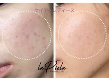 韓国発！最新ピーリング<ラピエラ>体験で、ツヤ感と透明感を。