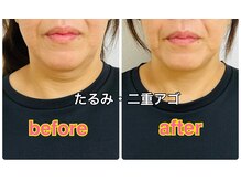 ダイエット×オーダーメイド整体/たるみ・二重アゴには鍼が効く◎