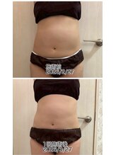 クールスパ(COOL SPA)/40代女性お腹症例