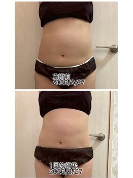 クールスパ(COOL SPA)/40代女性お腹症例