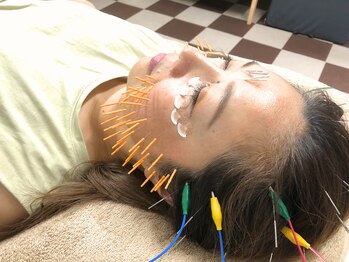 クローバー治療院/施術例:目の下たるみ、頭痛