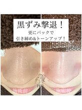 エクラ バイ シャンリィ(eclat by shanLy)/黒ずみ撃退！