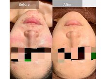 エミルカ 岡山店(EMILUCA)/お顔の施術事例