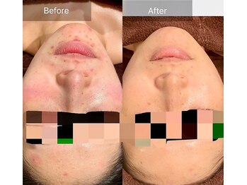 エミルカ 岡山店(EMILUCA)/お顔の施術事例