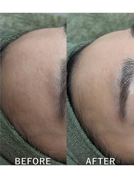 サロンドジェシカ(salon de Jessica)/プラズマ＋毛穴洗浄