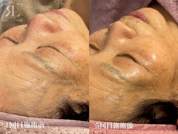 シャリル(charire)/陶肌トリートメント継続の効果