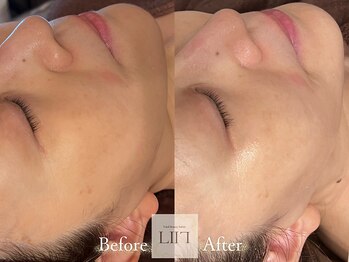 エル 麻布十番/たるみ/小顔/毛穴/フェイシャル