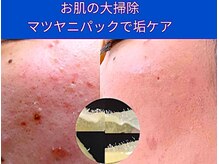 シエスタ 新小岩の雰囲気（毛穴、垢、肌荒れのケアに。お肌の大掃除をしましょう。）
